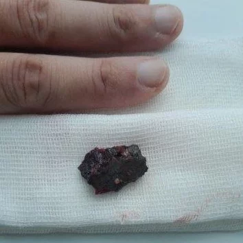 Кузбасские хирурги извлекли из груди пациента 4-сантиметровый осколок снаряда
Кузбасские хирурги извлекли из груди пациента 4-сантиметровый осколок снаряда